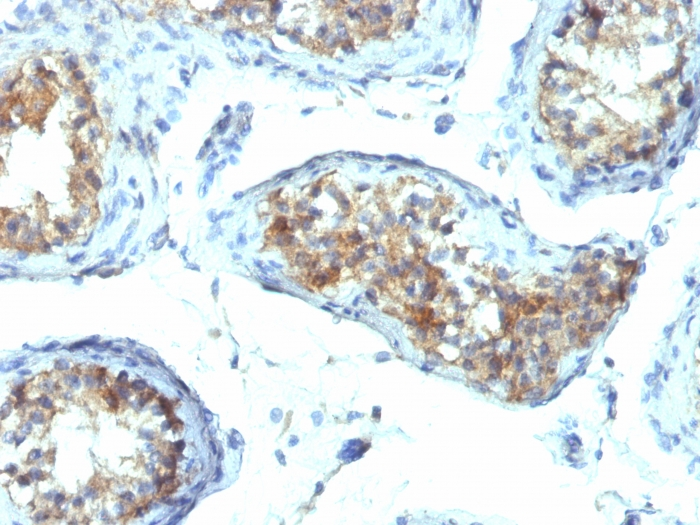 IHC-P analysis of human testicular carcinoma tissue using GTX34794 Interferon gamma antibody [IFNG/466].