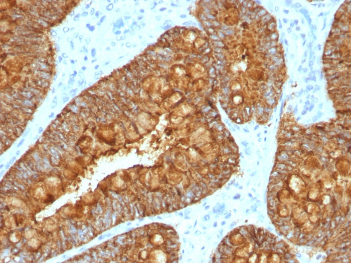 IHC-P analysis of human colon carcinoma tissue using GTX34815 MAML3 antibody [MAML3/1303].