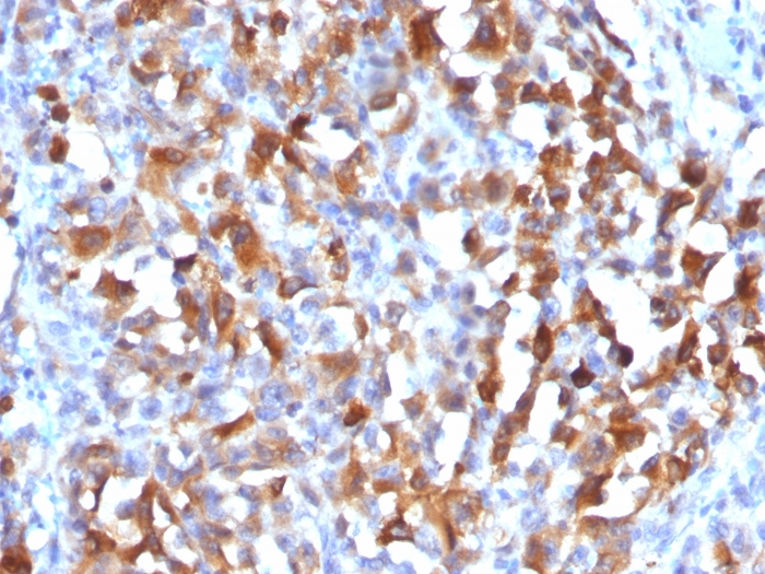 IHC-P analysis of human melanoma tissue using GTX34822 Melan A antibody. IHC-P analysis of human melanoma tissue using GTX34822 Melan A antibody.