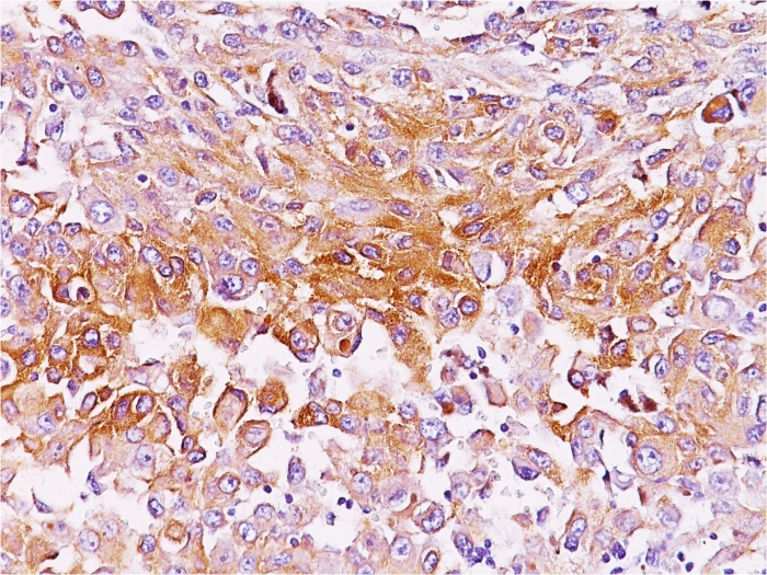 Formalin-fixed,paraffin-embedded human Melanoma stained with gp100 / Melanosome Monoclonal Antibody (NKI-beteb),