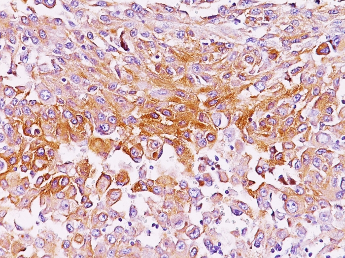 Formalin-fixed,paraffin-embedded human Melanoma stained with gp100 Monoclonal Antibody (SPM286).
