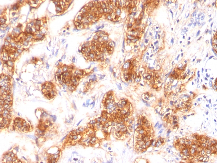 IHC-P analysis of human breast carcinoma tissue using GTX34840 Milk Fat Globule 1 antibody [SPM291].
