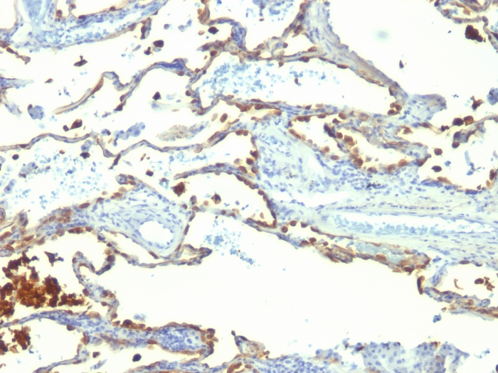 IHC-P analysis of human lung carcinoma tissue using GTX34840 Milk Fat Globule 1 antibody [SPM291].