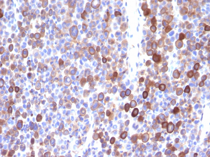 IHC-P analysis of human melanoma tissue using GTX34846 Moesin antibody [MSN/491].