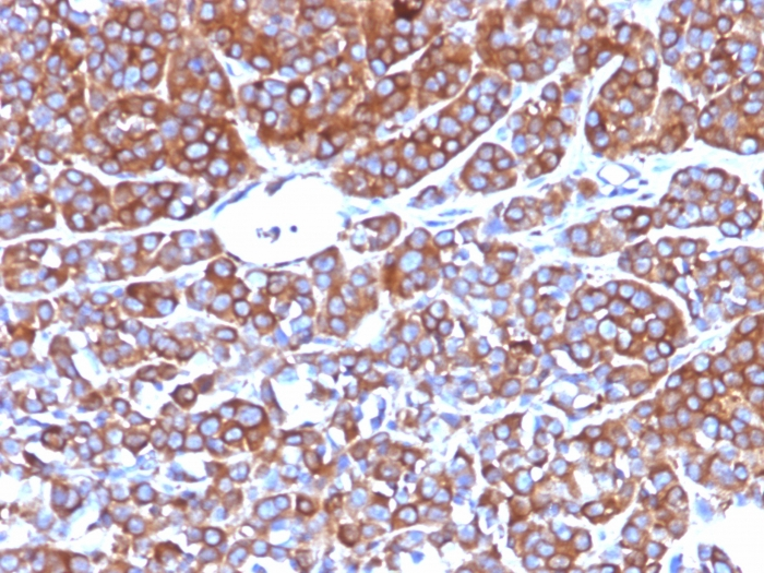 IHC-P analysis of human melanoma tissue using GTX34848 Moesin antibody [MSN/492].