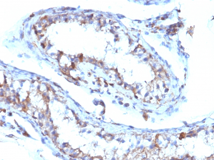 IHC-P analysis of human testicular carcinoma tissue using GTX34849 Moesin antibody [MSN/493].