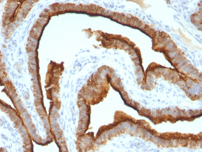 IHC-P analysis of human ovarian carcinoma tissue using GTX34854 MUC1 antibody [MUC1/967].