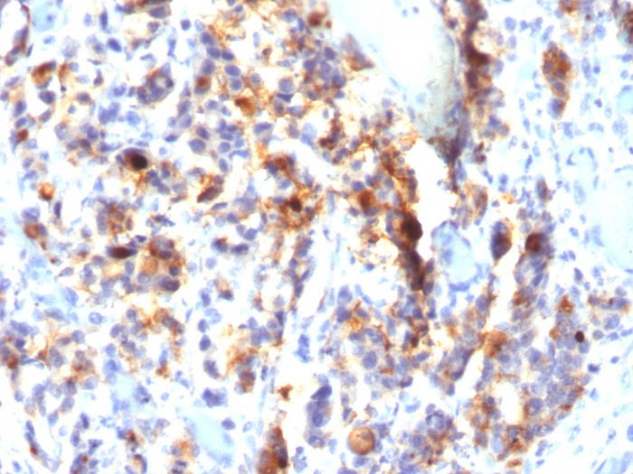 Formalin-fixed,paraffin-embedded human Gastric Carcinoma stained with MUC5AC Monoclonal Antibody (SPM297).