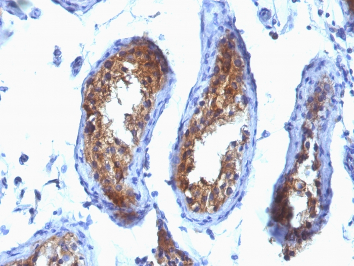 IHC-P analysis of human testicular carcinoma tissue using GTX34877 MVP/LRP antibody [SPM280].