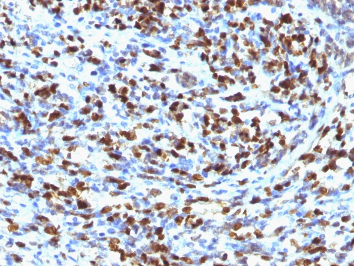 Formalin-fixed,paraffin-embedded Rhabdomyosarcoma stained with Myogenin Monoclonal Antibody (MGN185)