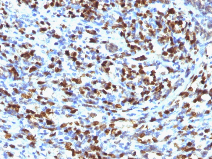 IHC-P analysis of human rhabdomyosarcoma tissue using GTX34884 Myogenin antibody [MGN185].