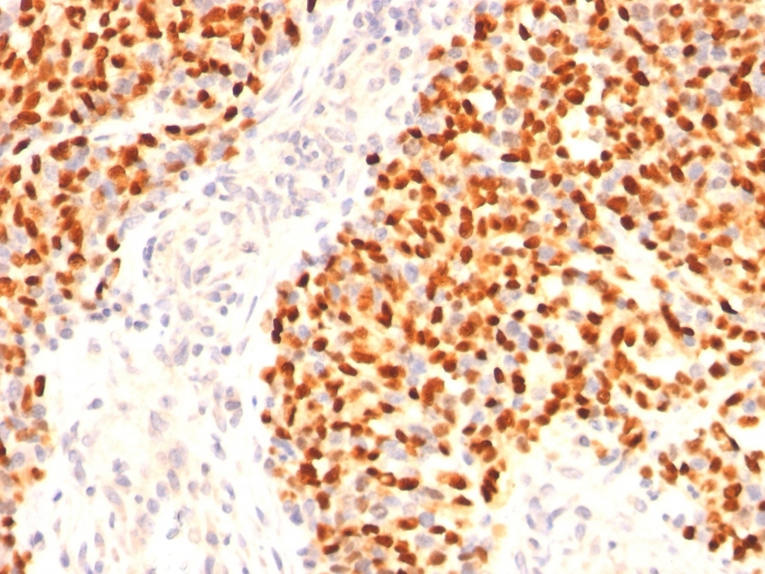 Formalin-fixed,paraffin-embedded human Rhabdomyosarcoma stained with Myogenin Monoclonal Antibody (F5D)