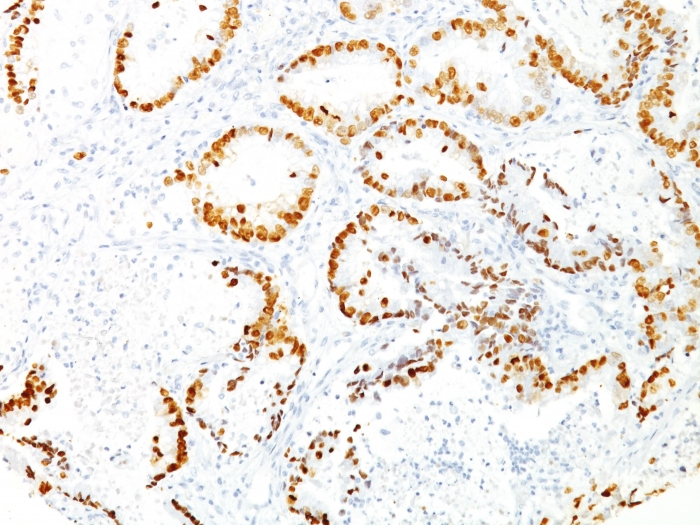 IHC-P analysis of human lung adenocarcinoma tissue using GTX34907 NKX2.1 antibody [8G7G3/1].