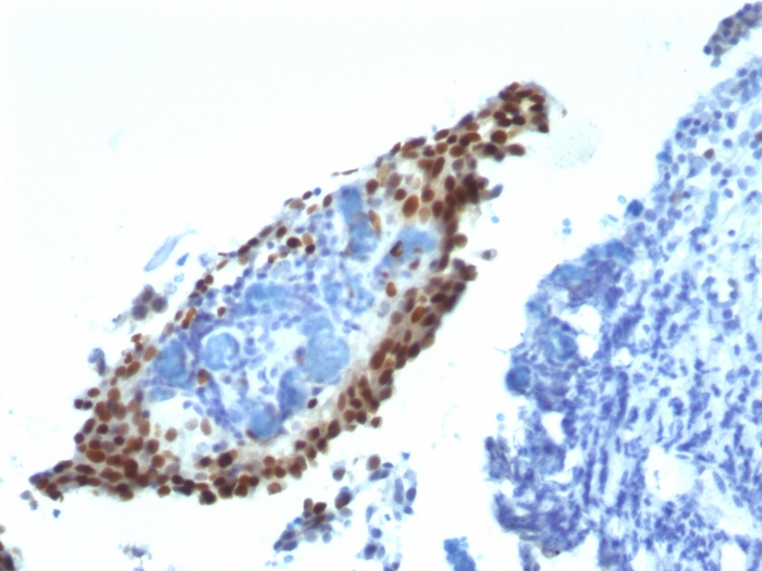 Formalin-fixed,paraffin-embedded Bladder Carcinoma stained with p21 Monoclonal Antibody (HJ21).