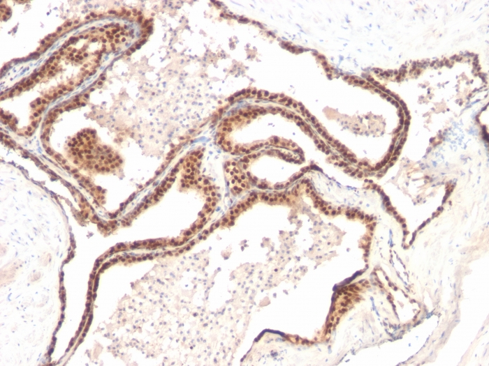 IHC-P analysis of human prostate carcinoma tissue using GTX34930 p27 Kip1 antibody [KIP1/769].
