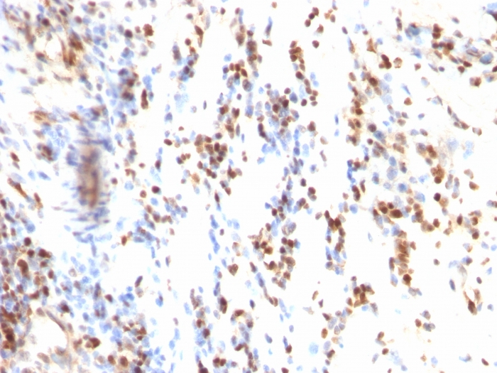 IHC-P analysis of human colon carcinoma tissue using GTX34930 p27 Kip1 antibody [KIP1/769].