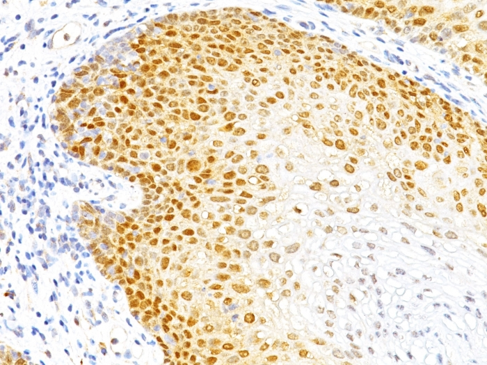 IHC-P analysis of human cervical cancer tissue using GTX34931 p27 Kip1 antibody [DCS-72.F6].