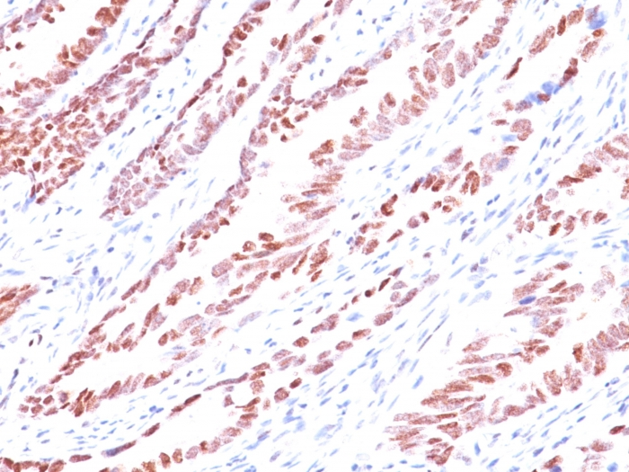 Formalin-fixed,paraffin-embedded human Colon Carcinoma stained with p57 Monoclonal Antibody (KP10).