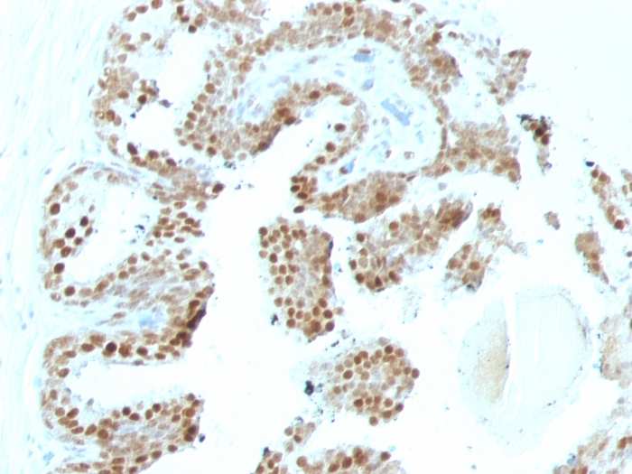 Formalin-fixed,paraffin-embedded human Prostate Carcinoma stained with p57 Monoclonal Antibody (SPM308).