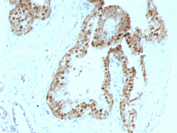 Formalin-fixed,paraffin-embedded human Prostate Carcinoma stained with p57 Monoclonal Antibody (KIP2/880).