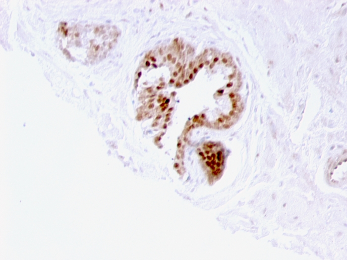 Formalin-fixed,paraffin-embedded human Bladder Carcinoma stained with p57 Monoclonal Antibody (57P06).
