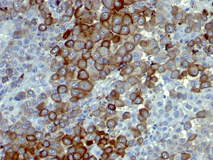 IHC-P analysis of human melanoma tissue using GTX34947 p75 NGF Receptor / CD271 antibody [NTR/912].