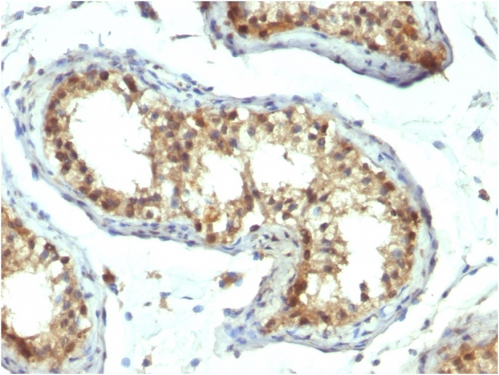 IHC-P analysis of human testicular carcinoma tissue using GTX34959 PAX7 antibody [PAX7/1187].