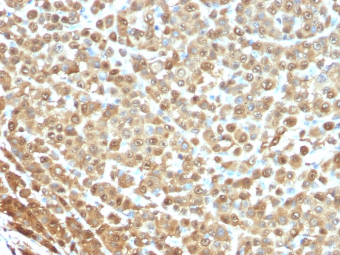 IHC-P analysis of human melanoma tissue using GTX34997 S100 alpha antibody [S1/61].