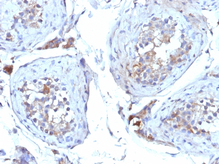 IHC-P analysis of human testicular carcinoma tissue using GTX35081 SHBG antibody [SHBG/245].