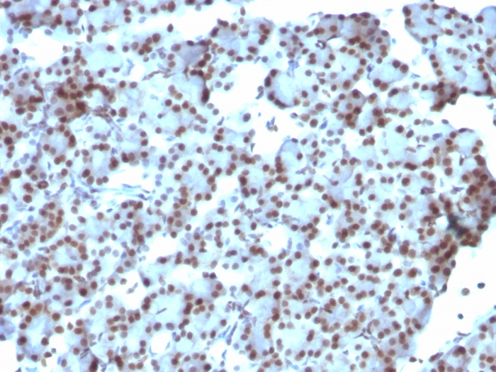 IHC-P analysis of human ovarian carcinoma tissue using GTX35094 SUMO1 antibody [SUMO1/1188].