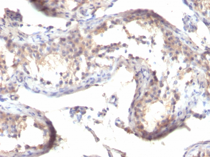 Formalin-fixed,paraffin-embedded human Testicular Carcinoma Stained with TGF alpha Monoclonal Antibody (MF9)
