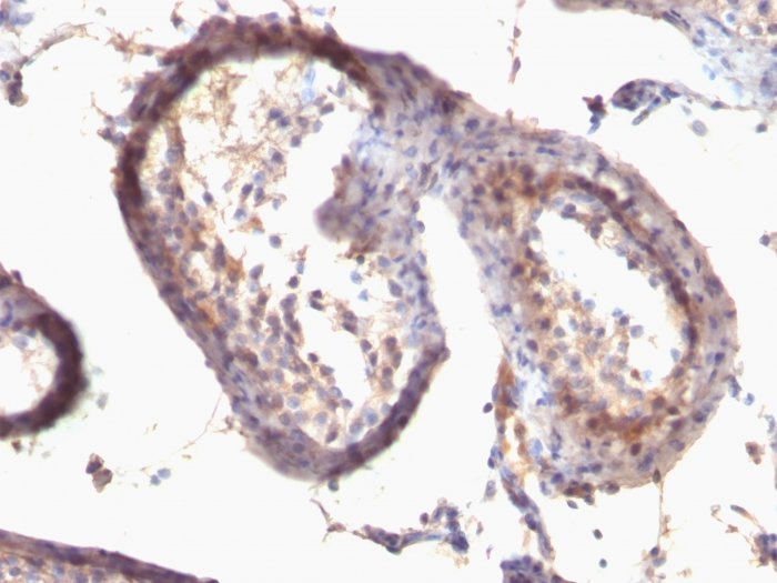 Formalin-fixed,paraffin-embedded human Testicular Carcinoma stained with TGF alpha Monoclonal Antibody (SPM542)