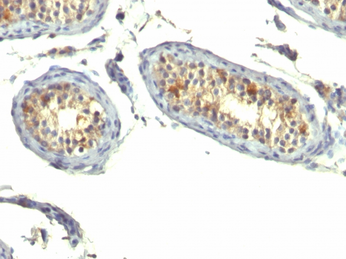 Formalin-fixed,paraffin-embedded human Testicular Carcinoma stained with TGF alpha Monoclonal Antibody (P/T1)