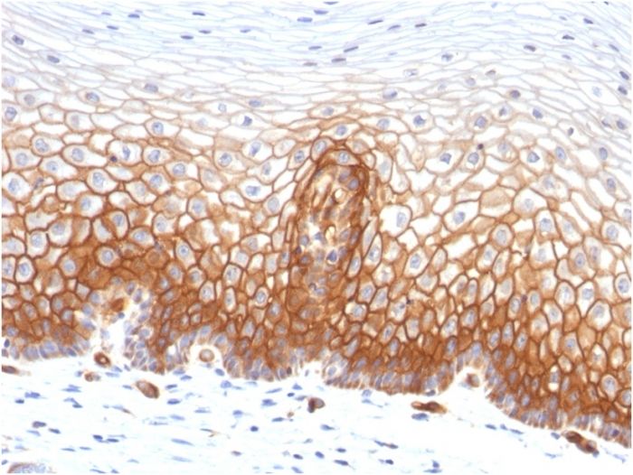 IHC-P analysis of human cervical carcinoma tissue using GTX35108 Thrombomodulin antibody [THBD/1591].