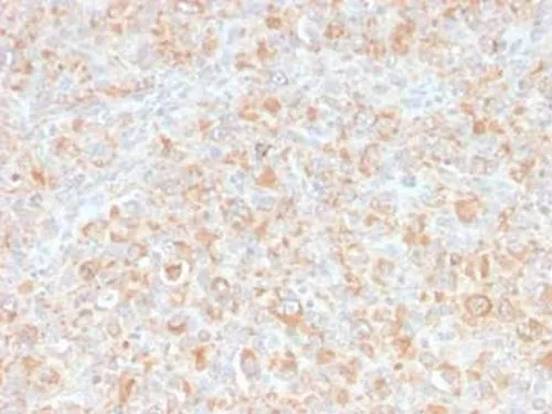 Formalin-fixed,paraffin-embedded human Erdheim Chester disease (also known as polyostotic sclerosing histiocytosis) stained with TNF alpha Monoclonal Antibody (SPM543).