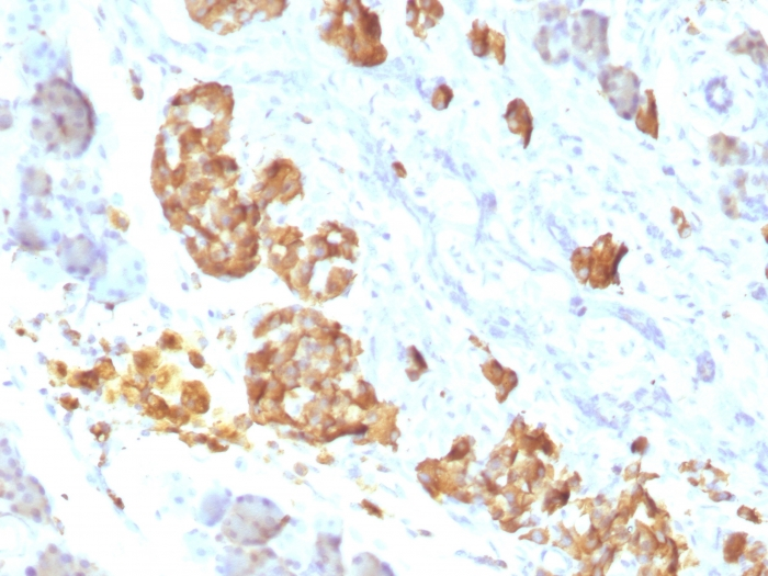 Formalin-fixed,paraffin-embedded human Erdheim Chester disease (also known as polyostotic sclerosing histiocytosis) stained with TNF alpha Monoclonal Antibody (P/T2).