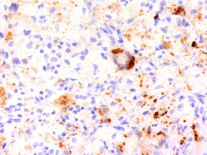 IHC-P analysis of human erdheim-chester disease (also known as polyostotic sclerosing histiocytosis) tissue using GTX35134 TNF alpha antibody [TNF706].