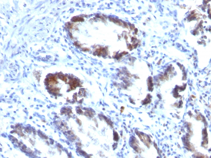 IHC-P analysis of human colon carcinoma tissue using GTX35141 Transgelin antibody [TAGLN/247].