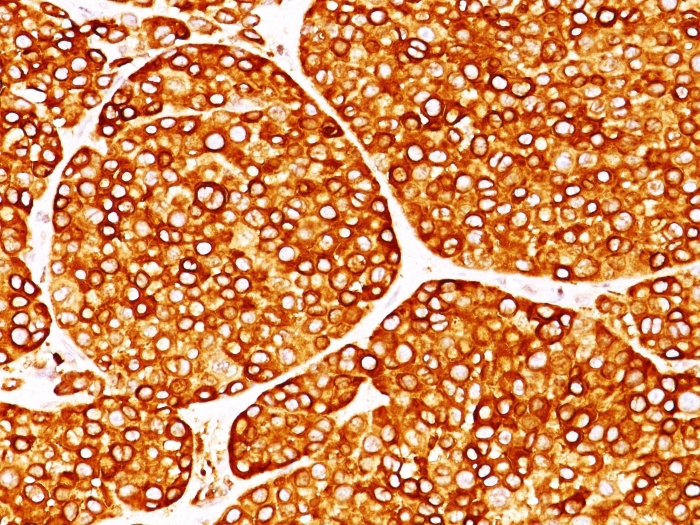 IHC-P analysis of melanoma tissue using GTX35154 Tyrosinase antibody [T311].