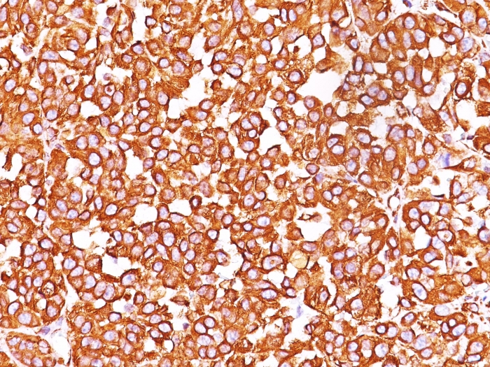 Formalin-fixed,paraffin-embedded human Melanoma stained with Vimentin Monoclonal Antibody (SPM576).