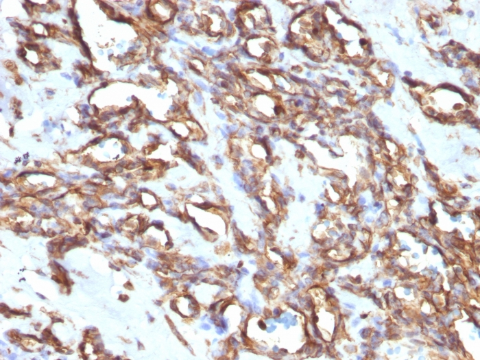 IHC-P analysis of human angiosarcoma tissue using GTX35163 Vimentin antibody [VM1170].