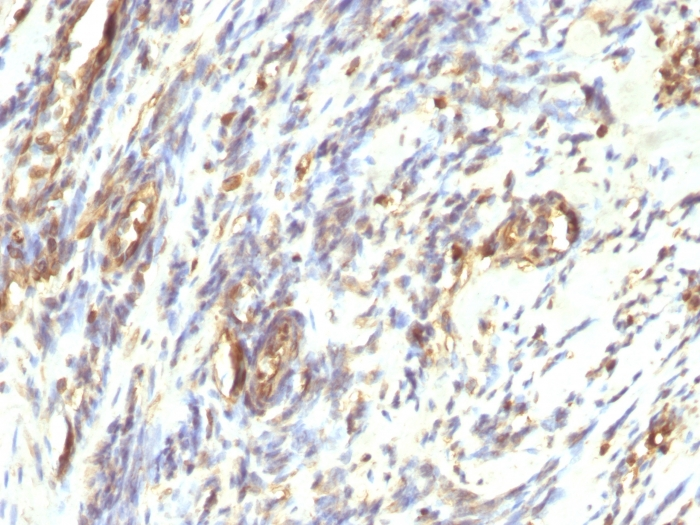 IHC-P analysis of human leiomyosarcoma tissue using GTX35163 Vimentin antibody [VM1170].