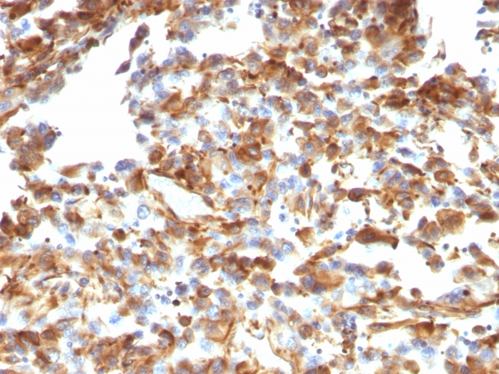 IHC-P analysis of human melanoma tissue using GTX35163 Vimentin antibody [VM1170].