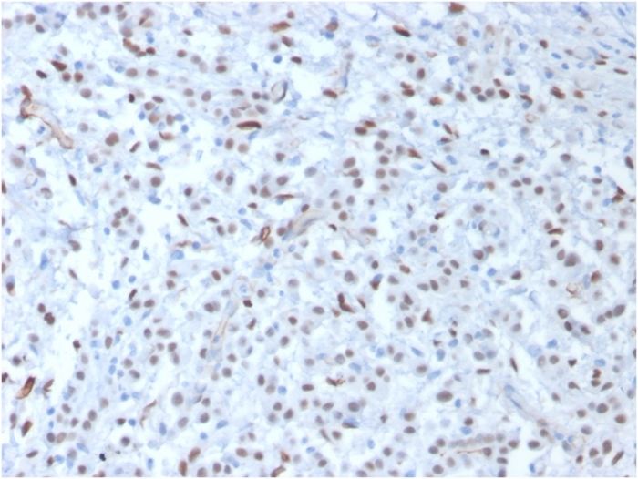 IHC-P analysis of human mesothelioma tissue using GTX35174 Wilms Tumor 1 antibody [WT1/857].
