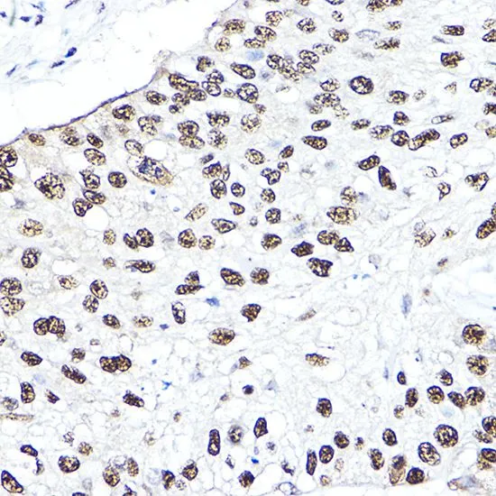 IHC-P analysis of human lung cancer tissue using GTX35197 NBS1 antibody. Dilution : 1:50