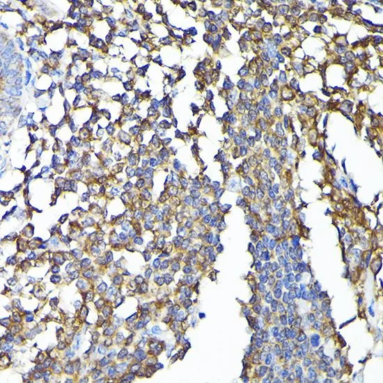 IHC-P analysis of human colon carcinoma tissue using GTX35201 CSK antibody. Dilution : 1:100