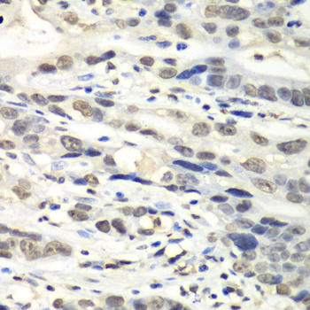 IHC-P analysis of human gastric cancer tissue using GTX35216 MTH1 antibody.  Dilution : 1:100