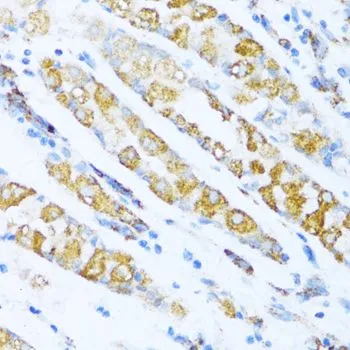 IHC-P analysis of human gastric cancer tissue using GTX35222 NDUFA5 antibody. Dilution : 1:100