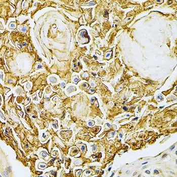 IHC-P analysis of human esophageal cancer tissue using GTX35230 GRK2 antibody. Dilution : 1:200 IHC-P analysis of human esophageal cancer tissue using GTX35230 GRK2 antibody. Dilution : 1:200