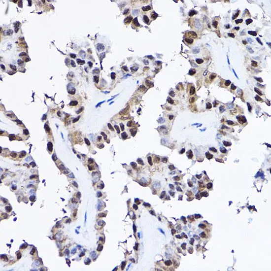 IHC-P analysis of human thyroid cancer tissue using GTX35232 PDCD4 antibody. Dilution : 1:25
